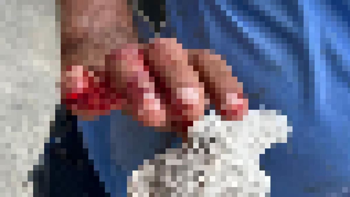 Apoyarán al trabajador de Servicios Públicos que perdió el dedo en riña con turista